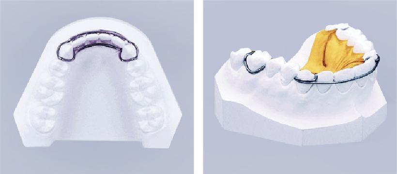 歯並びがきれいになったら、動かした歯が安定するまで、取り外しのできる保定装置（リテーナー）を使用していただきます。