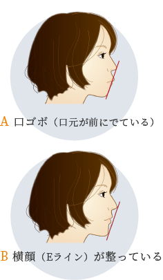 口ゴボと整った横顔の比較イメージ