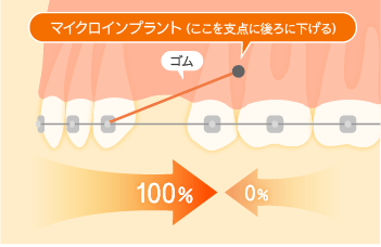 アンカースクリューによる治療