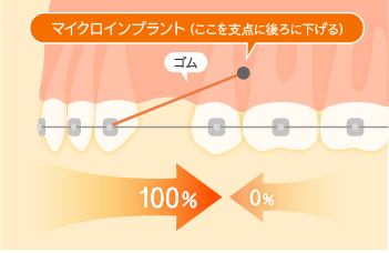 マイクロインプラントによる治療