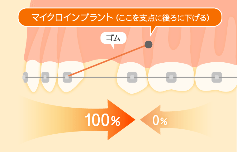 アンカースクリューによる治療