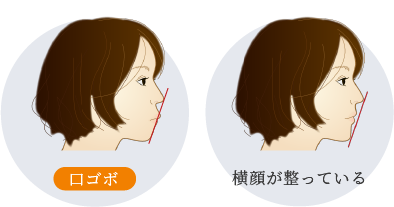 口ゴボと整った横顔の比較イメージ