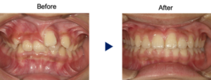 歯茎から歯が生えている症例