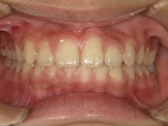 歯茎から歯が生えている治療後