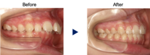 隙間がある出っ歯の症例