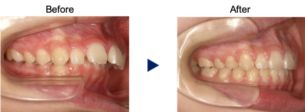 隙間がある出っ歯の症例