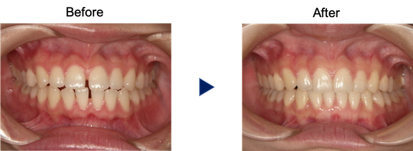 上下のすきっ歯治療前後
