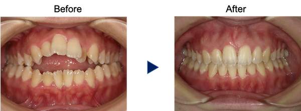 重度の開咬治療前後