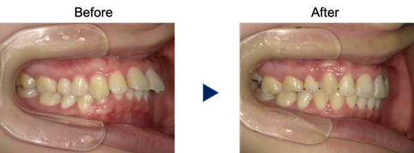 前歯２本の出っ歯の治療前後