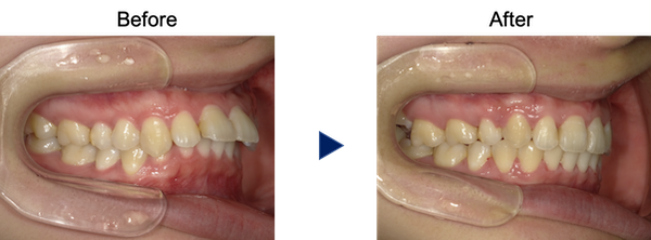 前歯２本だけ飛び出した出っ歯の症例 岐阜県大垣市のよろず矯正歯科