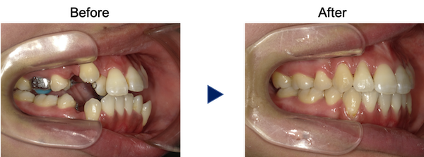 重度のガタガタの歯並び