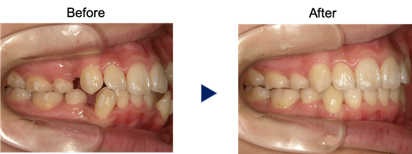 上下ガタガタの歯並び