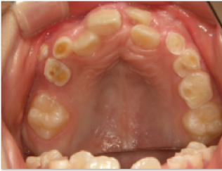埋伏過剰歯で歯並びが悪い 大垣市のよろず矯正歯科