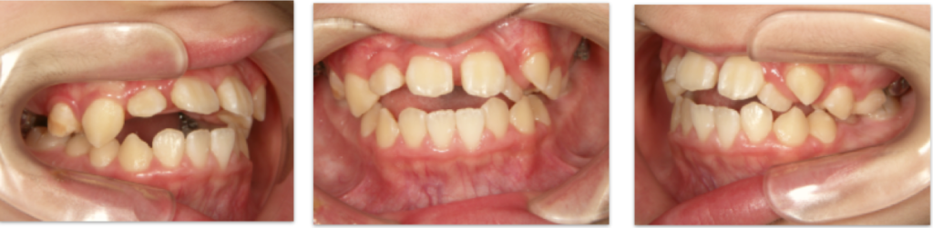 埋伏過剰歯で歯並びが悪い 大垣市のよろず矯正歯科