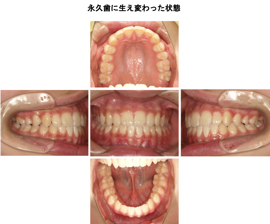 乳歯から永久歯の歯並び