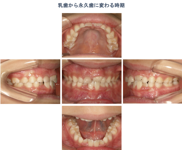 乳歯から永久歯に生え変わる時の歯並び 大垣市のよろず矯正歯科