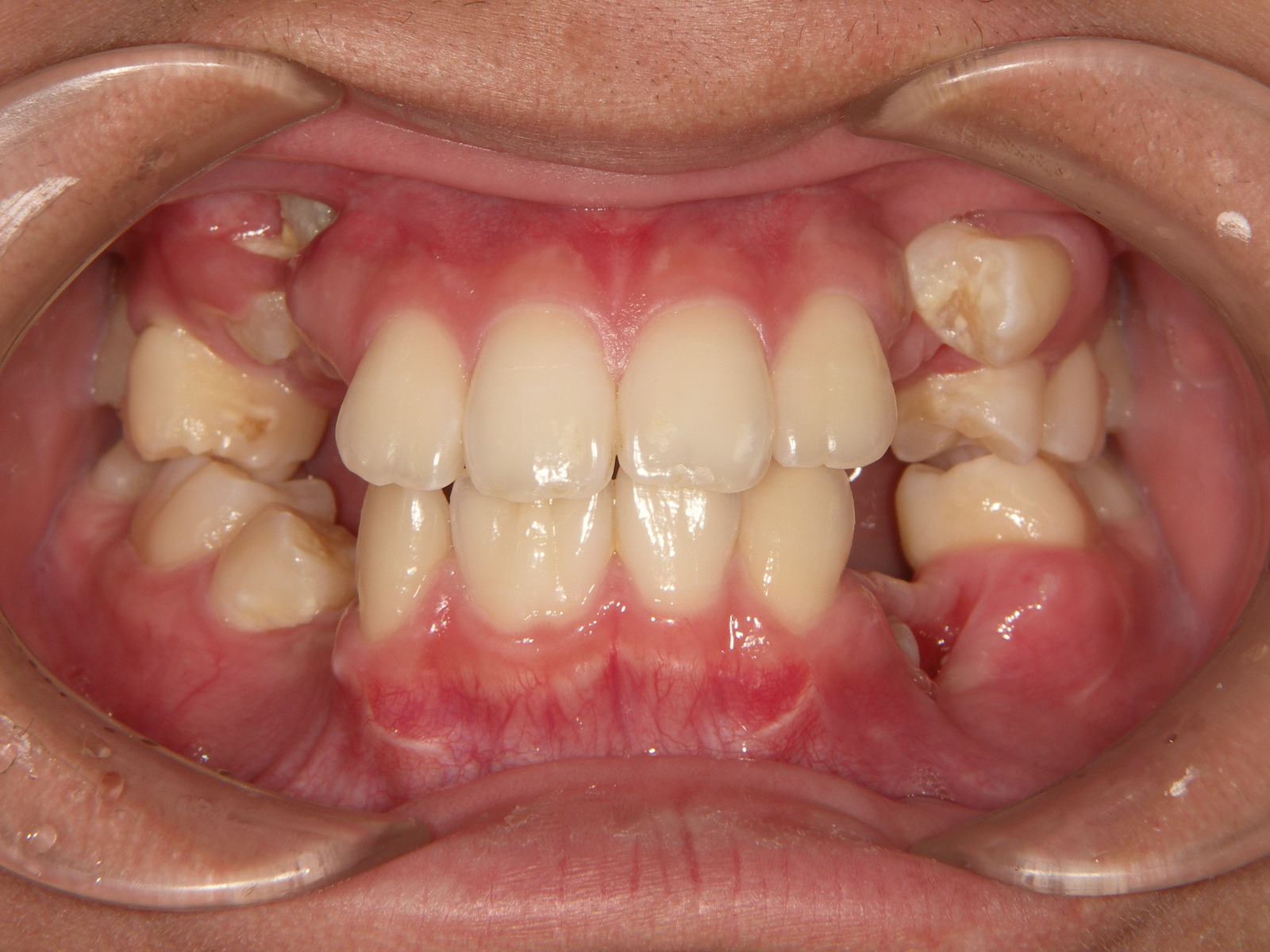 歯茎 の 横 から 歯