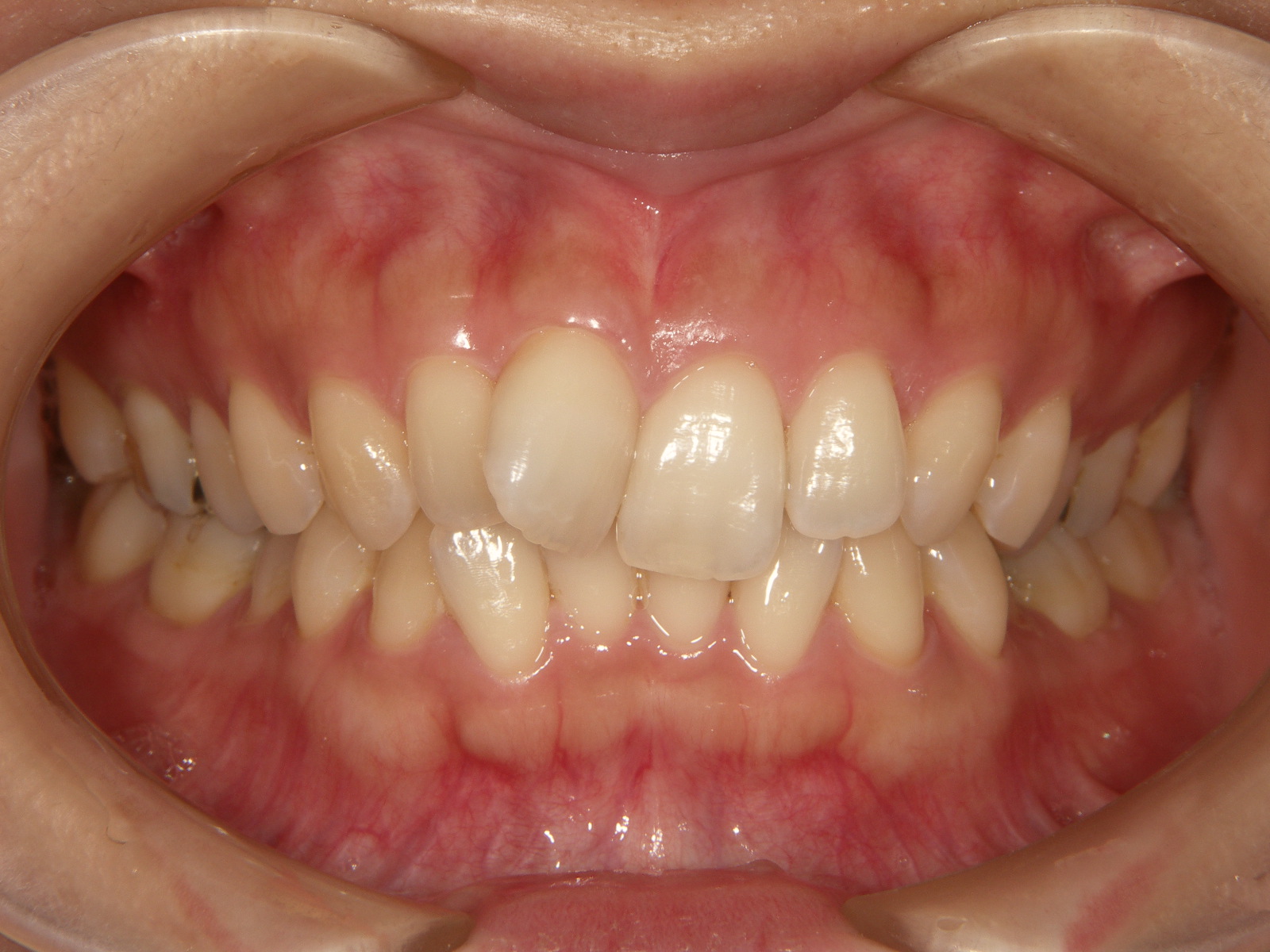 前歯 が 内側 に 傾い て いる