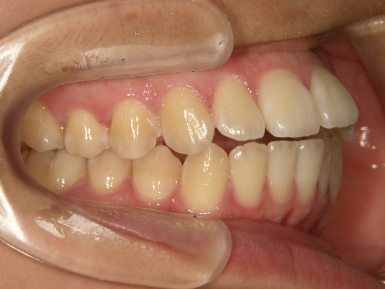 矯正治療後の後戻り 岐阜県大垣市のよろず矯正歯科