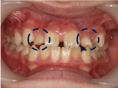 矮小歯 小さい歯 があり すきっ歯に見える 岐阜県大垣市のよろず矯正歯科