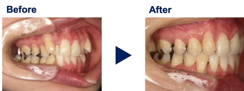 八重歯が目立つ歯並び 岐阜県大垣市のよろず矯正歯科