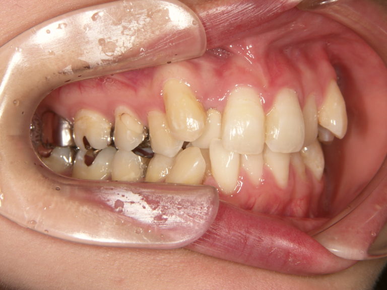 てる 犬歯 尖っ 人間の歯で一番尖っている歯『犬歯（八重歯）』を探ろう！