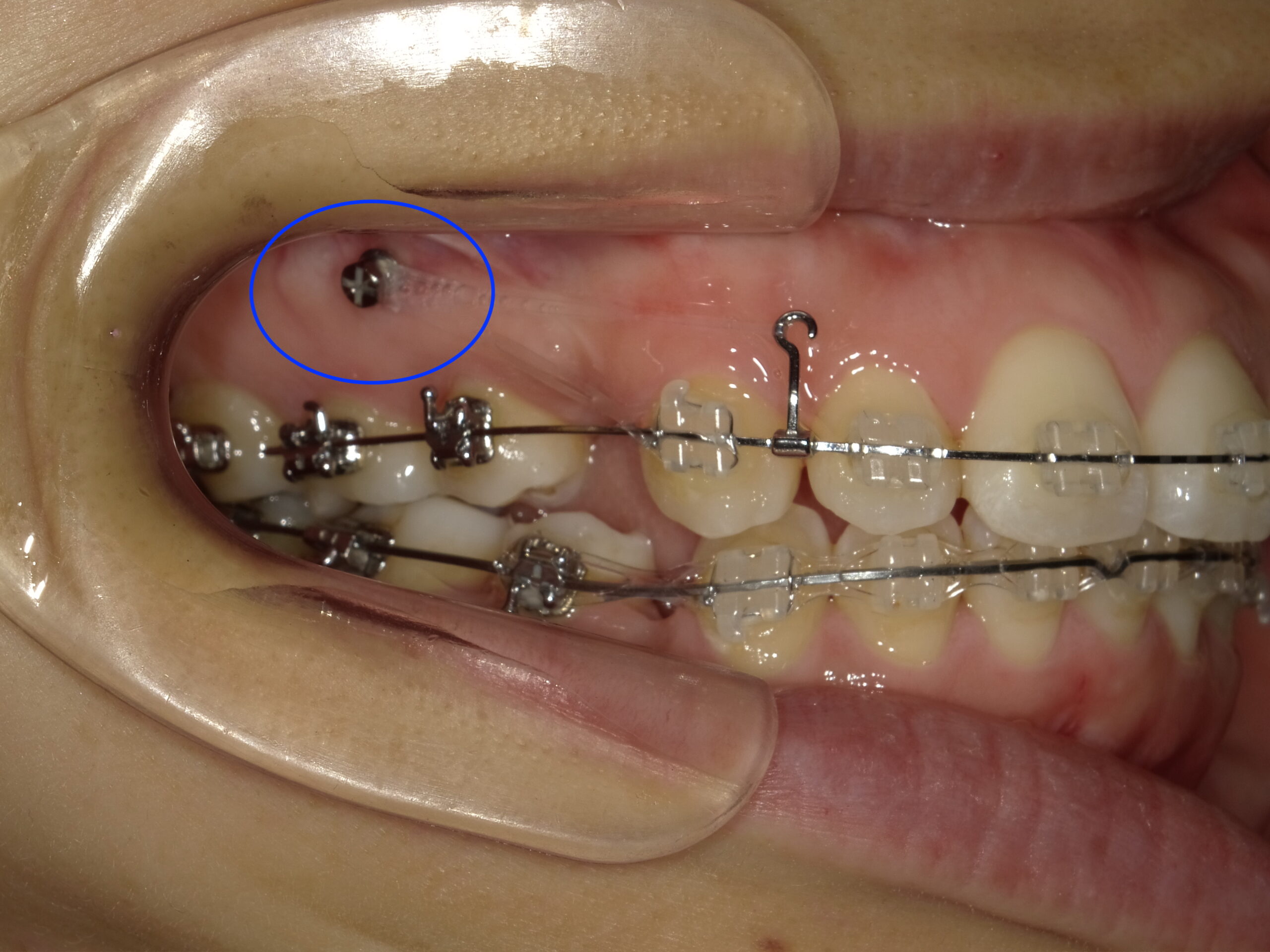 頬側に埋入した例