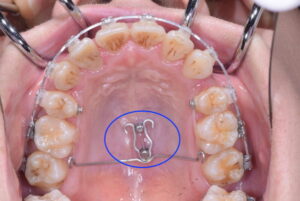 口蓋正中に埋入した例