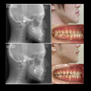 受け口の矯正治療