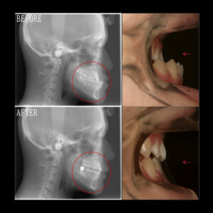 受け口の矯正治療