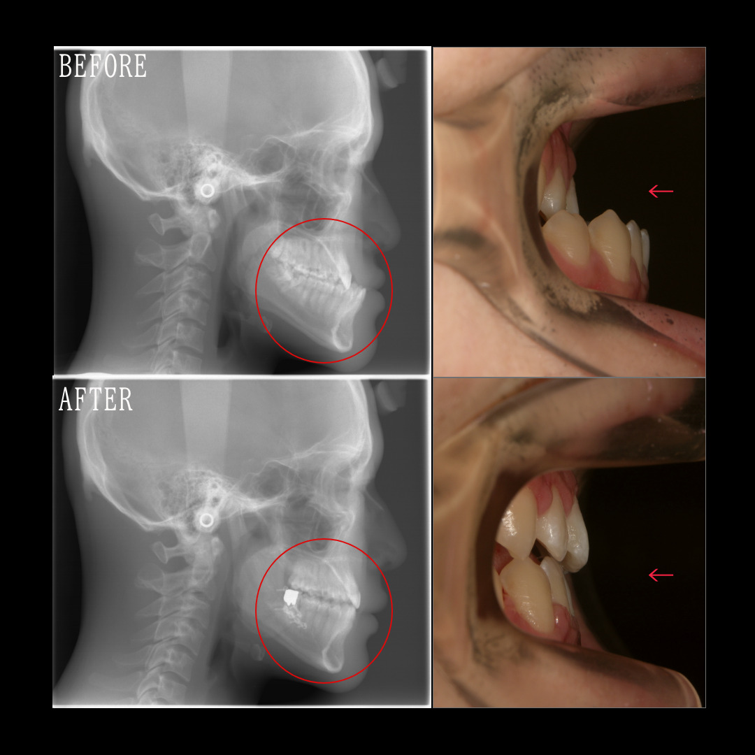 受け口の矯正治療