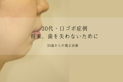 口ゴボ矯正治療
