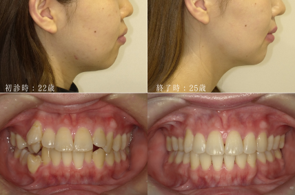 20代の矯正治療口ゴボ
